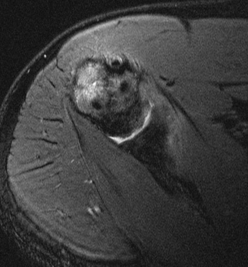 Figure 4 for case Greater tuberosity fracture and capsular sprain